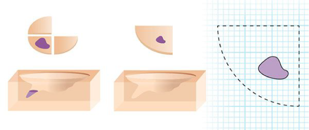 dermatólogo Oncólogo en Bogotá Cirugía de Mohs